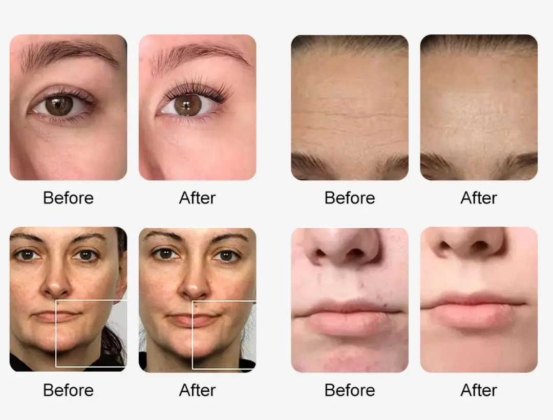 Before and After HydraFacial Results